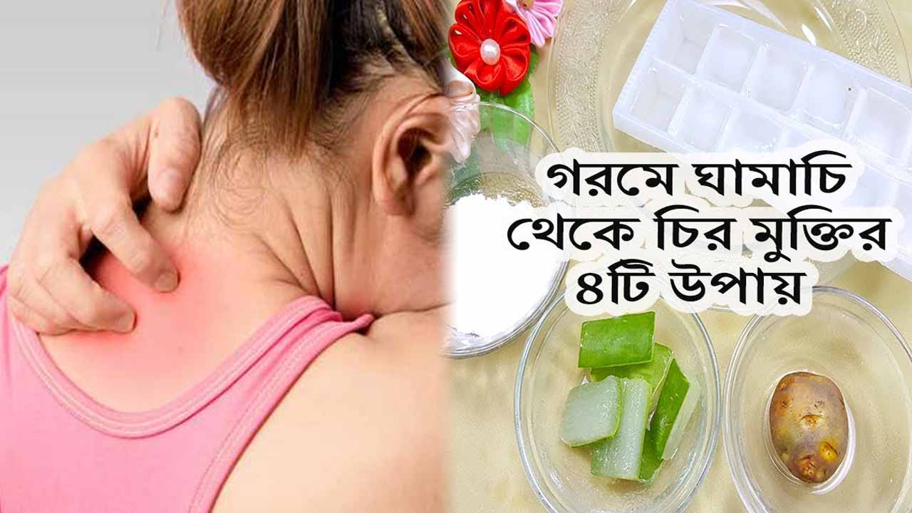 গরমে ঘামাচির সমস্যায় ভুগছেন? রইল মুক্তি পাওয়ার ঘরোয়া টিপস